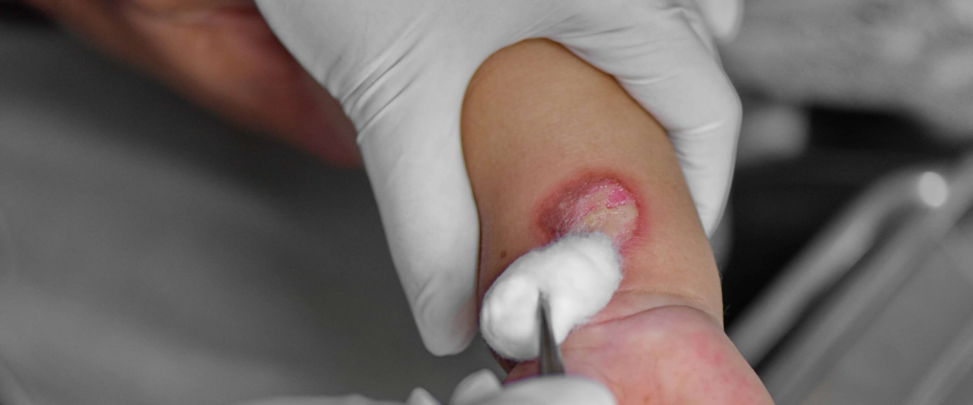 Tips for Managing 2nd Degree Burn Healing Stages