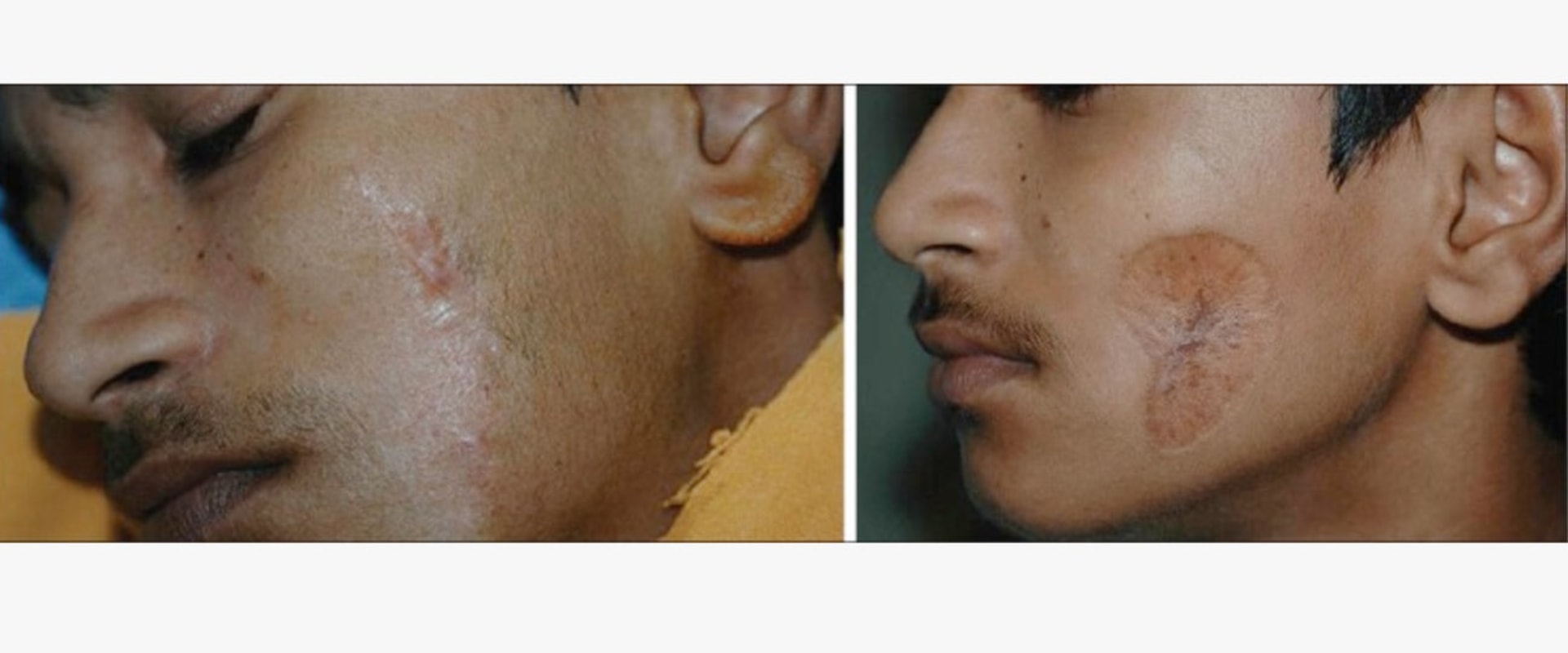 Scar Revision Surgery: How Cosmetic Surgery Can Remove Scars