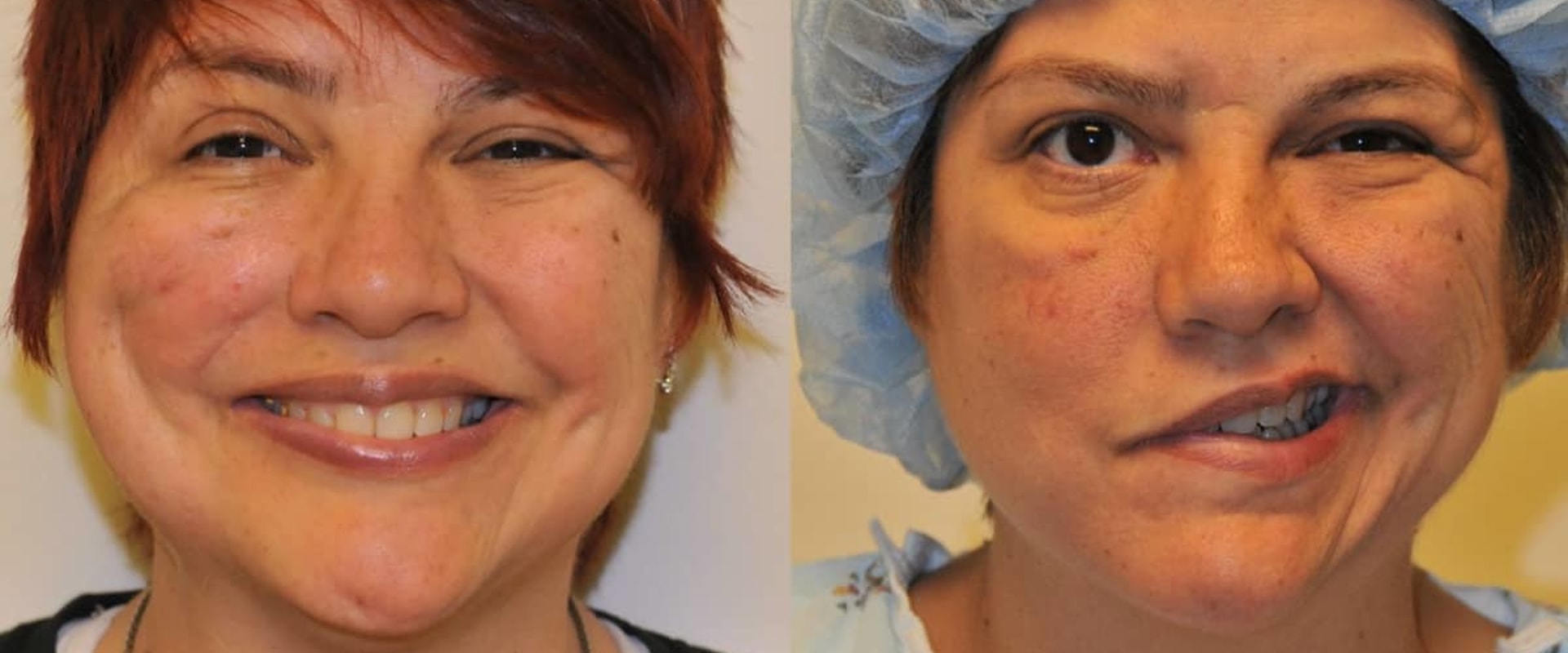 Is Plastic Surgery on Face Painful? A Comprehensive Guide