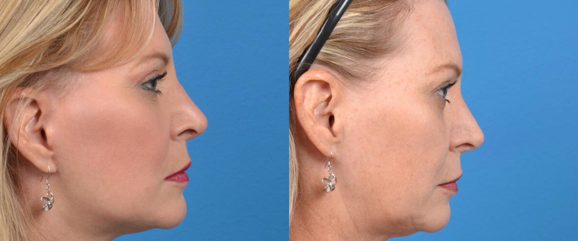 Are Cosmetic Surgery and Plastic Surgery Different?