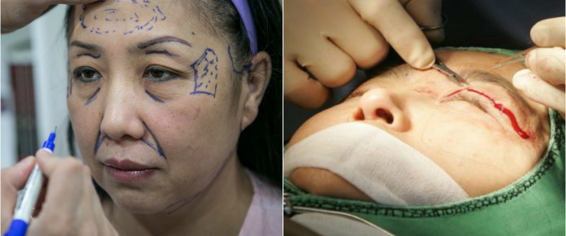 Everything You Need to Know About Cosmetic Surgery