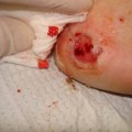 Effective Ways to Relieve Skin Ulcer Symptoms