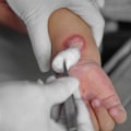 Tips for Managing 2nd Degree Burn Healing Stages