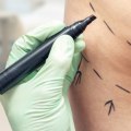 Which cosmetic surgery is the most dangerous?
