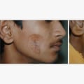 Scar Revision Surgery: How Cosmetic Surgery Can Remove Scars