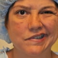 Is Plastic Surgery on Face Painful? A Comprehensive Guide
