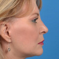 Are Cosmetic Surgery and Plastic Surgery Different?