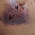 The Risks and Dangers of Cosmetic Surgery