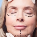 Can You Deduct the Cost of Cosmetic Surgery on Your Taxes?