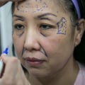 Everything You Need to Know About Cosmetic Surgery