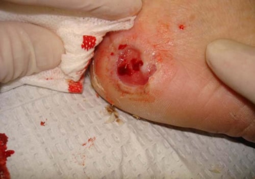 Effective Ways to Relieve Skin Ulcer Symptoms