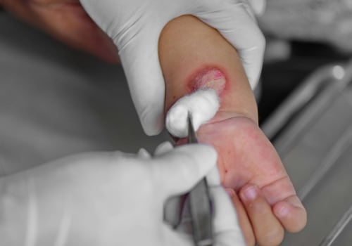 Tips for Managing 2nd Degree Burn Healing Stages