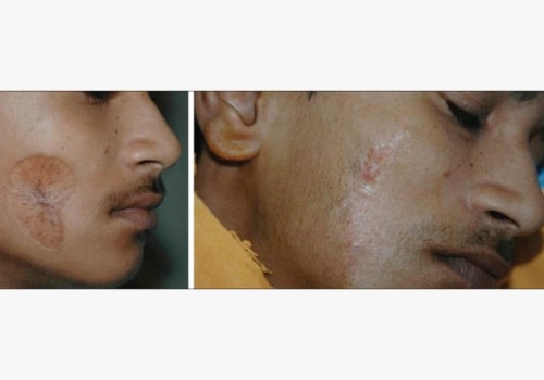 Scar Revision Surgery: How Cosmetic Surgery Can Remove Scars