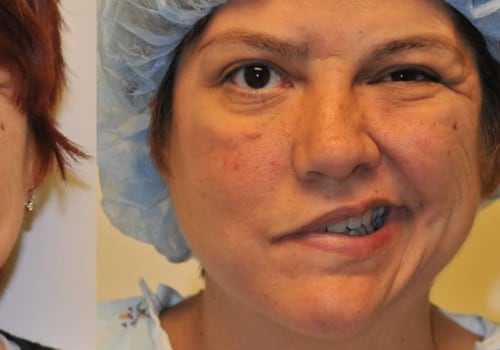 Is Plastic Surgery on Face Painful? A Comprehensive Guide