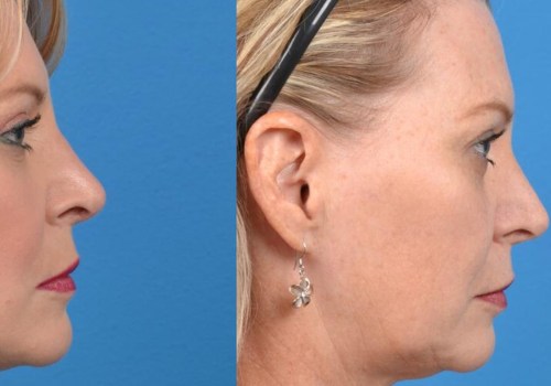 Are Cosmetic Surgery and Plastic Surgery Different?