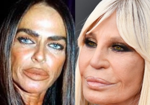 When Cosmetic Surgery Goes Wrong: The Risks and Horror Stories
