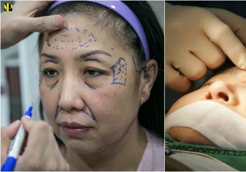 Everything You Need to Know About Cosmetic Surgery